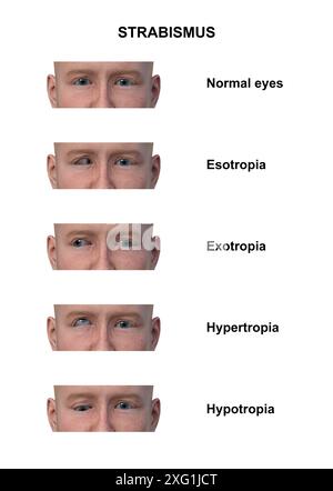 Illustration étiquetée d'un homme avec différents types de strabisme : ésotropie, exotropie, hypertropie et hypotropie. Banque D'Images