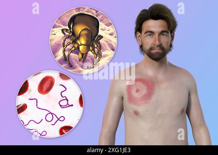 Illustration montrant un érythème migrant, une éruption cutanée caractéristique observée chez des patients atteints de la maladie de Lyme. La bactérie responsable Borrelia burgdorferi et le vecteur typique de tique sont tous deux montrés en gros plan. Banque D'Images