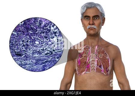 Illustration d'un homme avec des poumons atteints de silicose, montrant des nodules silicotiques foncés, et un gros plan de tissu pulmonaire endommagé. La silicose décrit les problèmes de santé respiratoire dus à l'exposition à la silice. Banque D'Images