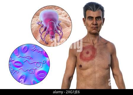 Illustration montrant un érythème migrant, une éruption cutanée caractéristique observée chez des patients atteints de la maladie de Lyme. La bactérie responsable Borrelia burgdorferi et le vecteur typique de tique sont tous deux montrés en gros plan. Banque D'Images