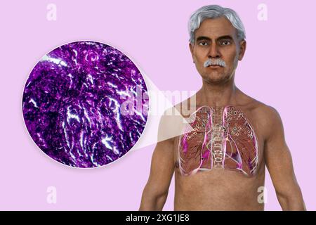 Illustration d'un homme avec des poumons atteints de silicose, montrant des nodules silicotiques foncés, et un gros plan de tissu pulmonaire endommagé. La silicose décrit les problèmes de santé respiratoire dus à l'exposition à la silice. Banque D'Images