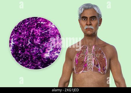 Illustration d'un homme avec des poumons atteints de silicose, montrant des nodules silicotiques foncés, et un gros plan de tissu pulmonaire endommagé. La silicose décrit les problèmes de santé respiratoire dus à l'exposition à la silice. Banque D'Images