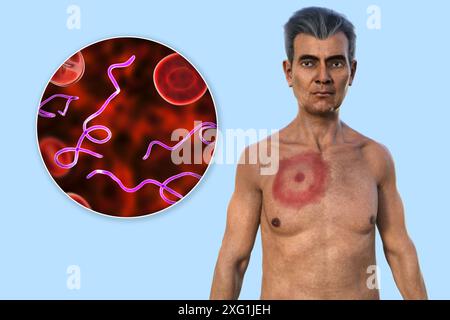 Illustration montrant un érythème migrant, une éruption cutanée caractéristique observée chez des patients atteints de la maladie de Lyme, et un gros plan de la bactérie Borrelia burgdorferi responsable. Cette bactérie est généralement transférée à l'homme par l'intermédiaire d'un vecteur d'insecte, comme une tique. Banque D'Images