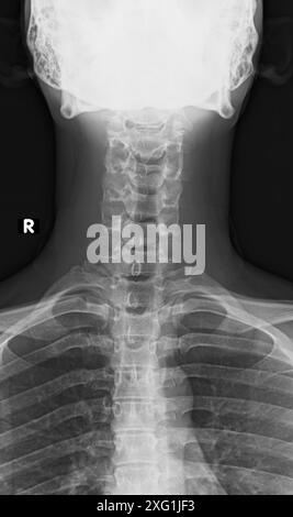 Radiographie de la région cervicale (cou) de la colonne vertébrale d'une personne saine. Banque D'Images