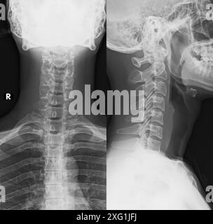 Radiographie de la région cervicale (cou) de la colonne vertébrale d'une personne saine. Banque D'Images