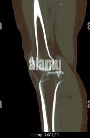 Tomodensitométrie (CT) colorée du genou d'un patient après un accident de voiture. Le ligament croisé postérieur (LPC) s’est séparé du tibia (os du mollet, bas), visible par le fragment osseux isolé à gauche. Cette blessure est fréquente dans les accidents de la route et nécessite généralement une intervention chirurgicale. Banque D'Images