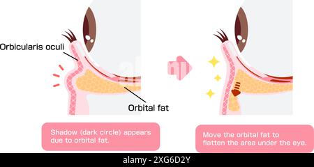 Comment enlever les cernes sous les yeux avec blépharoplastie inférieure (blépharoplastie transconjonctivale) Illustration de Vecteur