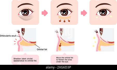 Comment enlever les cernes sous les yeux avec blépharoplastie inférieure (blépharoplastie transconjonctivale) Illustration de Vecteur