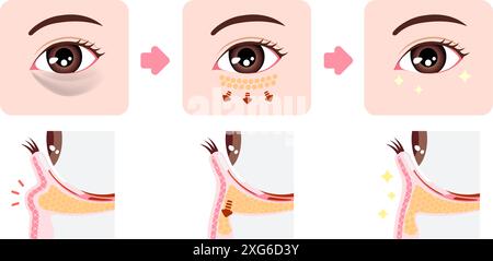 Comment enlever les cernes sous les yeux avec blépharoplastie inférieure (blépharoplastie transconjonctivale) Illustration de Vecteur