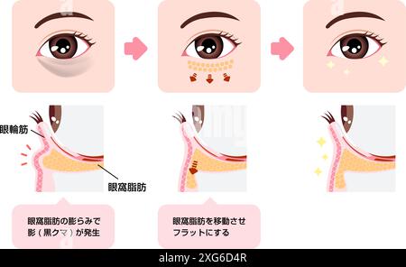 Comment enlever les cernes sous les yeux avec blépharoplastie inférieure (blépharoplastie transconjonctivale) Illustration de Vecteur