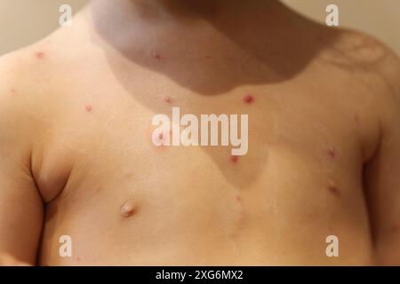 Jeune enfant avec cloques du virus de la varicelle Banque D'Images