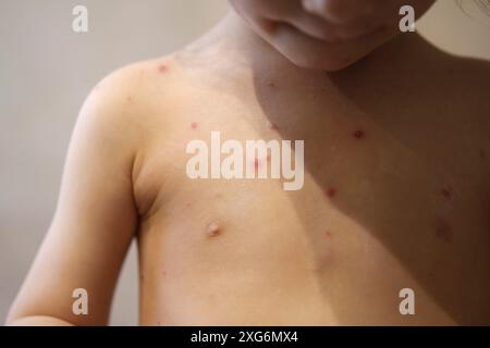 Jeune enfant avec cloques du virus de la varicelle Banque D'Images