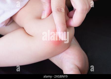 mère appliquant la crème antiallergique au genou de bébé avec éruption cutanée et allergie avec tache rouge causée par piqûre de moustique Banque D'Images