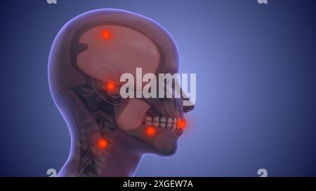 Douleur référée à partir de points de déclenchement musculaires dans la musculature masticatrice et cou-épaule Banque D'Images