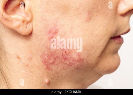 Gros plan du visage d'une femme montrant l'état de la peau avec rougeurs et boutons, soulignant les problèmes dermatologiques Banque D'Images