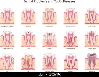 Infographie des problèmes dentaires. Carie dentaire humaine, problème de cavité buccale brochure dentiste dentiste sensible soins de dentiste saigner la gomme caries pulpite émail traitement racine illustration vectorielle chic Illustration de Vecteur