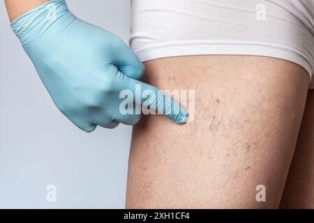 le médecin montre la dilatation des petits vaisseaux sanguins de la peau sur la jambe. Inspection médicale et traitement des télangiectasies. Banque D'Images