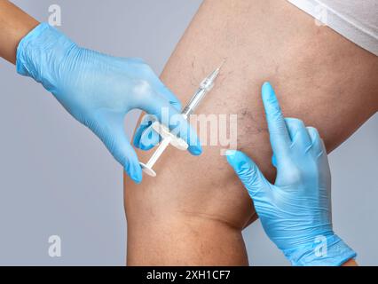 Un médecin fait une procédure médicale sclérothérapie utilisée pour éliminer les varices et les veines d'araignée. Injection d'une solution directement dans la veine. Banque D'Images