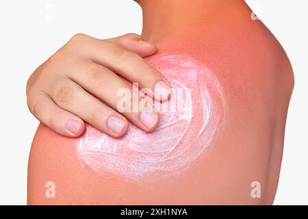 Un homme avec la peau rougie et qui démange après un coup de soleil. Soin de la peau et protection contre les rayons ultraviolets du soleil. Concept de cosmétologie Banque D'Images