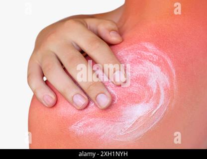 Un homme avec la peau rougie et qui démange après un coup de soleil. Soin de la peau et protection contre les rayons ultraviolets du soleil. Concept de cosmétologie Banque D'Images