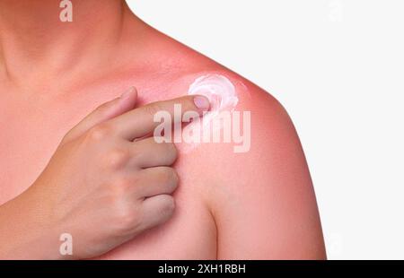 Un homme avec la peau rougie et qui démange après un coup de soleil. Soin de la peau et protection contre les rayons ultraviolets du soleil. Concept de cosmétologie Banque D'Images