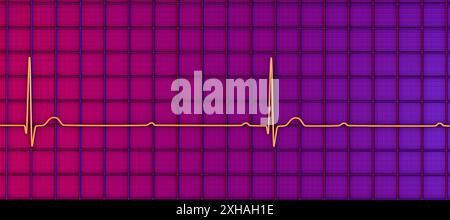 Illustration d'un électrocardiogramme (ECG) représentant un bloc cardiaque complet (3ème bloc auriculo-ventriculaire). L'ECG montre une dissociation complète entre les rythmes auriculaire et ventriculaire. Banque D'Images