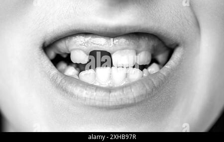 Gros plan d'un enfant avec problème de perte de dents de bébé. Bouche ouverte d'un petit garçon avec des dents mal poussées en gros plan. Concept d'orthodontie Banque D'Images