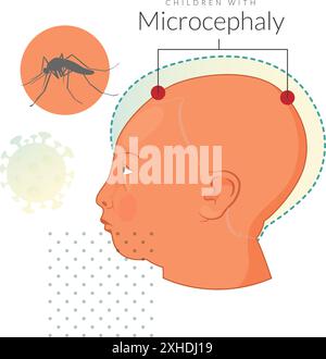 Enfants atteints de microcéphalie - virus Zika - illustration en tant que fichier EPS 10 Illustration de Vecteur