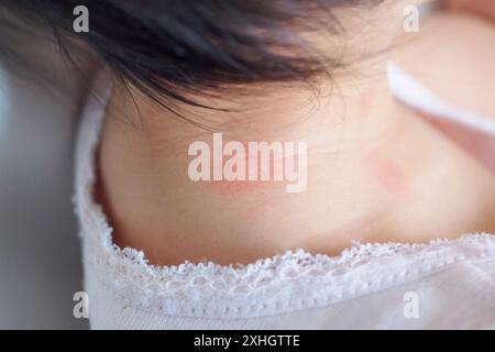 éruption cutanée de bébé et allergie avec tache rouge causée par une piqûre de moustique au cou Banque D'Images