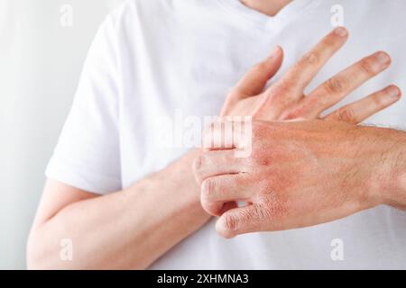 Homme gratte ou montre les mains avec la peau sèche et fissurée sur fond blanc. Problème avec beaucoup de gens - eczéma sur la main, allergies ou peau sèche. Voiture de santé Banque D'Images