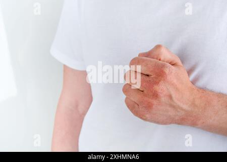 Homme gratte ou montre les mains avec la peau sèche et fissurée sur fond blanc. Problème avec beaucoup de gens - eczéma sur la main, allergies ou peau sèche. Voiture de santé Banque D'Images