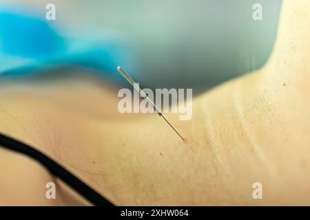 Traitement d'acupuncture à aiguille sèche. Thérapie Spa médicale féminine Banque D'Images