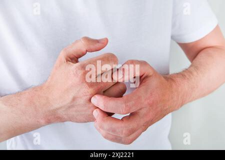 Homme gratte ou montre les mains avec la peau sèche et fissurée sur fond blanc. Problème avec beaucoup de gens - eczéma sur la main, allergies ou peau sèche. Voiture de santé Banque D'Images