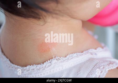 éruption cutanée de bébé et allergie avec tache rouge causée par une piqûre de moustique au cou Banque D'Images