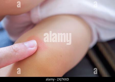 mère appliquant la crème antiallergique au genou de bébé avec éruption cutanée et allergie avec tache rouge causée par piqûre de moustique Banque D'Images