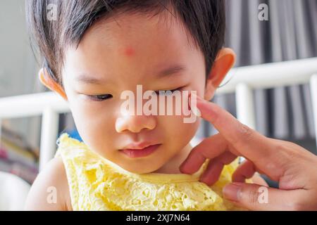 mère appliquant la crème de médecine antiallergique au visage mignon de fille asiatique avec éruption cutanée et allergie avec tache rouge cause par piqûre de moustique Banque D'Images