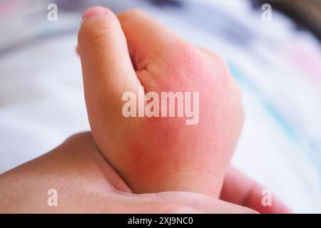 main de bébé avec éruption cutanée et allergie avec tache rouge causée par piqûre de moustique Banque D'Images