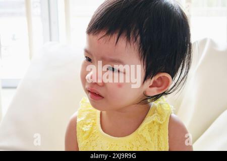 Mignonne petite fille asiatique avec une tache rouge d'allergie sur le visage causée par une piqûre d'insecte Banque D'Images