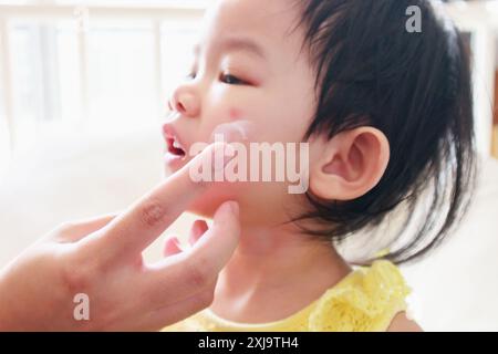 mère appliquant la crème de médecine antiallergique au visage mignon de fille asiatique avec éruption cutanée et allergie avec tache rouge cause par piqûre de moustique Banque D'Images