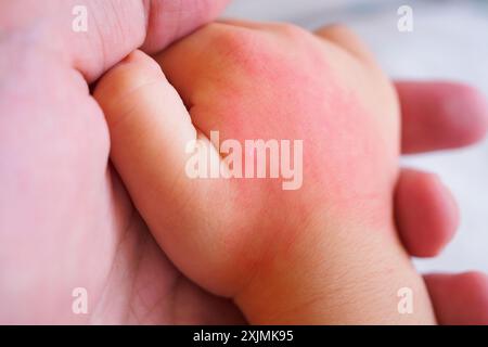 main de bébé avec éruption cutanée et allergie avec tache rouge causée par piqûre de moustique Banque D'Images