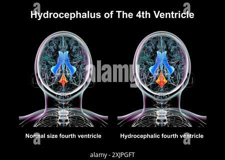Illustration représentant un agrandissement isolé du quatrième ventricule cérébral (droit) par rapport au quatrième ventricule de taille normale (gauche), vue de dessus. Banque D'Images