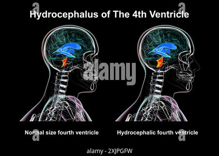 Illustration représentant un agrandissement isolé du quatrième ventricule cérébral (droit) par rapport au quatrième ventricule de taille normale (gauche), vue latérale. Banque D'Images