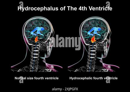 Illustration représentant un agrandissement isolé du quatrième ventricule cérébral (droit) par rapport au quatrième ventricule de taille normale (gauche). Banque D'Images