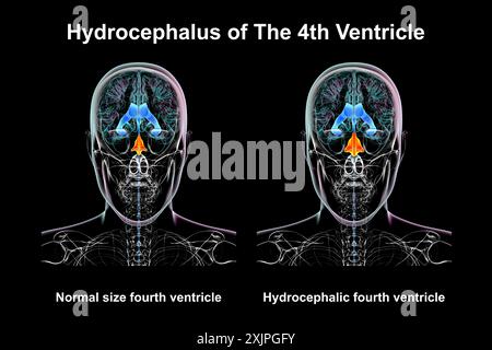 Illustration représentant un agrandissement isolé du quatrième ventricule cérébral (droit) par rapport au quatrième ventricule de taille normale (gauche), vue de face. Banque D'Images