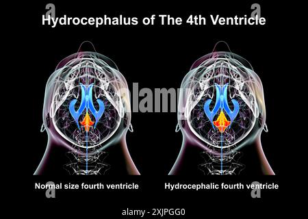Illustration représentant un agrandissement isolé du quatrième ventricule cérébral (droit) par rapport au quatrième ventricule de taille normale (gauche), vue de dessous. Banque D'Images