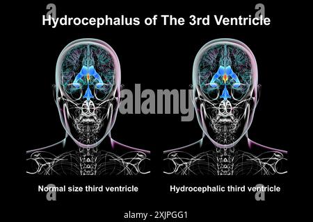Illustration représentant un agrandissement isolé du troisième ventricule cérébral (droit) par rapport au troisième ventricule de taille normale (gauche), vue de face. Banque D'Images
