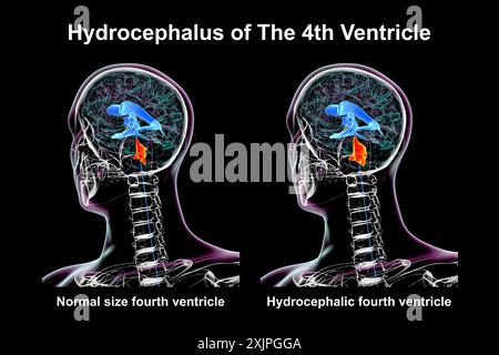 Illustration représentant un agrandissement isolé du quatrième ventricule cérébral (droit) par rapport au quatrième ventricule de taille normale (gauche). Banque D'Images