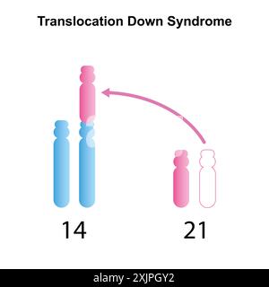 Syndrome de Down de translocation, illustration. Banque D'Images