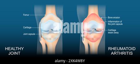 Polyarthrite rhumatoïde. Une comparaison entre un genou sain et une articulation avec l'érosion osseuse, le cartilage s'use, l'espace articulaire réduit et le synov enflé Illustration de Vecteur