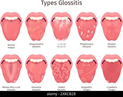 Glossite. Types de maladie de la langue écarlate, problèmes de dents douloureuses de bouche humaine en bonne santé ou malade xérostomie muguet atrophique infections bactériennes ulcères illustration vectorielle chic Illustration de Vecteur